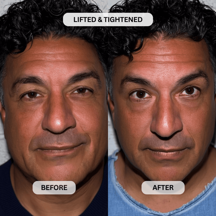 Micro - Infusion System For Upper Eyelids (Men) - Botanique Paris