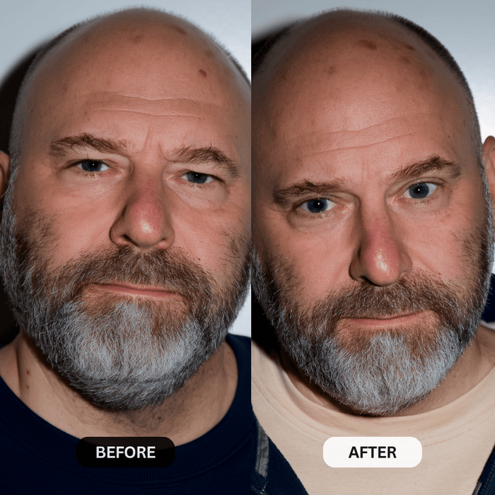 Micro - Infusion System For Upper Eyelids (Men) - Botanique Paris