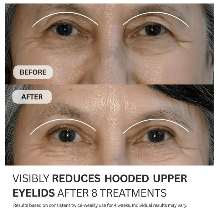 Micro - Infusion System For Hooded Eyelids - Botanique Paris