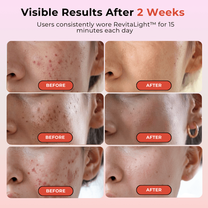 RevitaLight™ Therapy Face Mask - Botanique Paris